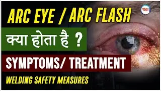 What is Arc Eye? What is Arc Flash? Arc Flash Explained | Welding Flash | Welding Safety