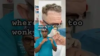 Восстановление линии роста волос с помощью пересадки волос #hairtransplantlondon #hairlinetranspl...