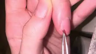 Fingernail Wooden Sliver Extraction 