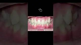 Teeth Transformation - Love To Smile