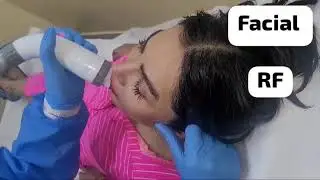 Correcting the mandibular angle ,eyebrows form ,rinkles,with radio frequency technique (RF)