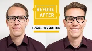How to conceal receding hairlines perfectly | Hairsystem for the front | Hairsystems Heydecke