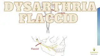 Flaccid Dysarthria, - flaccid dysarthria characteristics, flaccid dysarthria causes