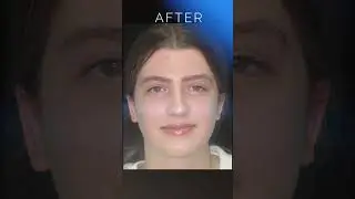 Otoplasty (Ear Pinning Surgery) Results: Before & After Pictures #cosmeticsurgery