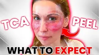 TCA Peel for the Eyes - My Day by Day Recovery