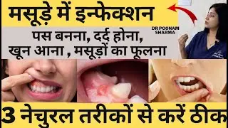 मसूड़ों में इन्फेक्शन,दर्द,पस ,खून आना,सूजन होना, ठीक करने के 3 घरेलु तरीके |  Masude Kaa Ilaaj