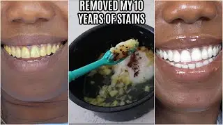 in two minutes remove 10 years of stains from teeth!! Results will Shock You