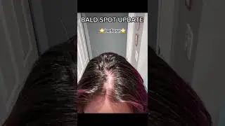 Bald spot regrowth update #femalehairloss #hairregrowthjourney