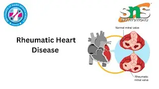 Case Study on Rheumatic Heart Disease | Pathology | SNS Institutions 