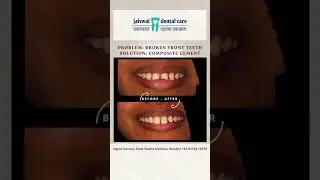 Broken teeth repaired in just 30 mins! #wardha #dentist #chippedteeth #brokenteeth #dentalproblems