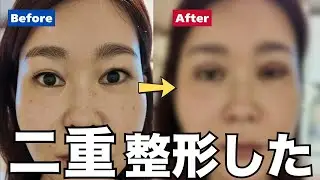【二重整形】ダンタイム1ヶ月の経過全部見せ！韓国で二重切開してきた！