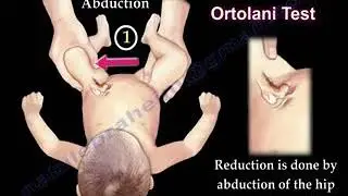 Ortolani's test