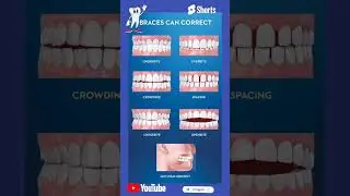 #What Braces can correct # tooth alignment # smile correction # dental shorts