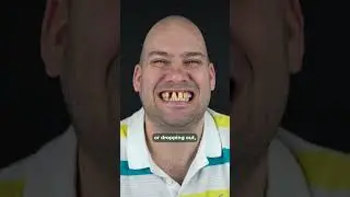 Full Mouth Restoration with Diabetes &mdash; Real Patient&rsquo;s Smile Journey at All On Dental Clinic