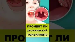 МОЖЕТ ЛИ ХРОНИЧЕСКИЙ ТОНЗИЛЛИТ ПРОЙТИ САМ?