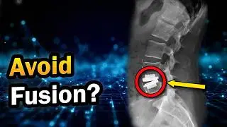 Spinal Fusion vs. Artificial Disc Replacement (ADR): Which is Better?