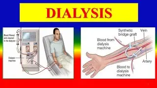 DIALYSIS - Definition , Types , Access , Principles,  Procedure,  Management , Patient , education