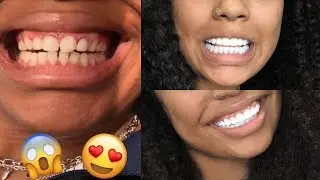 I TRAVELED TO CALI COLOMBIA TO GET MY TEETH DONE w/ DR MARIO MONTOYA | Vlogmas Day 1