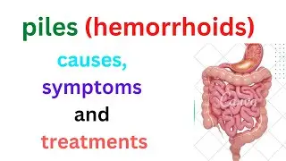 Piles (Hemorrhoid) Causes, Symptoms & Natural Treatment | Dr Ramakant Sharma