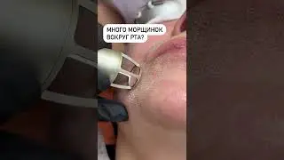 Процедура проводится на аппарате Candela CO2RE. 👌🏻