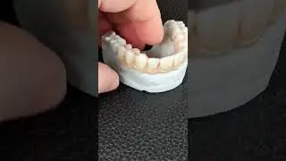 Full Arch Zirzonia on Titanium Bar in Exocad with printed MUA analogs