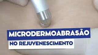 A microdermoabras&atilde;o no rejuvenescimento | Dr. Jo&atilde;o Tassinary