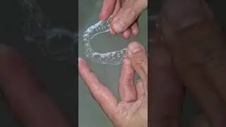 3Dresyns 3D printed aligner printed with 3Dresyn OD-Clear TF LTP Flexible at 0.7mm with LCD printers