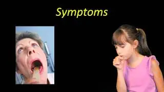 Laryngitis