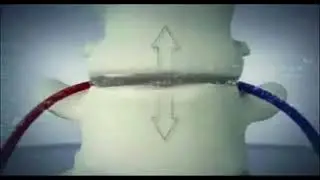 IDD Therapy for Back Pain & Sciatica. Video shows how IDD Therapy alleviates bulging discs.