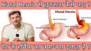 पेट का हर्निया (हाइटस हर्निया) का इलाज़ | Hiatus Hernia Treatment | Dr Arvind Namdeo