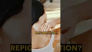 Vitiligo? Autoimmune Triggers and Repigmentation Potential