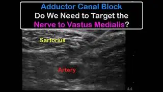 Adductor Canal Block - Does Nerve to Vastus Medialis Have To Be SEPARATELY Targeted?