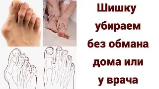 Шишка на стопе - причины, исправление дома или у врача