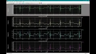 Design of Low-Power and Area-Efficient ECG Low-Pass Filter Using VSCP