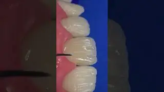 new reel #teethcare #dentist #teeth