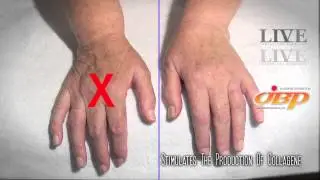 Ultrazvukov&aacute; &scaron;pachtle Derma