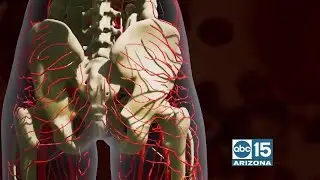 Advantage IR offers alternative treatment to surgery for BPH
