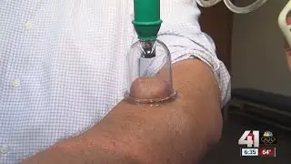 Cupping therapy for athletes