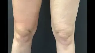 Как избавиться от целлюлита. Медицинский квест