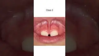 Upper Lip Tie Class 1 - 4 #shorts @fauquierent