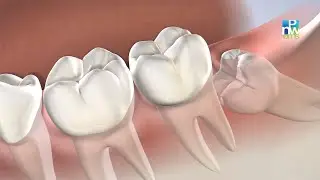 Post-Operative Instructions: Wisdom Teeth Removal | Pacific Northwest Oral & Maxillofacial Surgeons