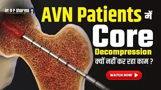 Why Are Core Decompression Cases Failing So Commonly | HIP AVN Treatment In Delhi-NCR - Dr DP Sharma