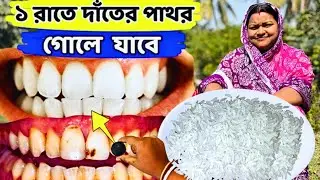 মিনিটে দাঁতের পাথর গোলে যাবে / Teeth cleaning