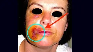 One Way to Prevent This!  (Sodium Hypochlorite Accident)