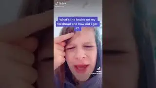 Biggy Buise in forehead