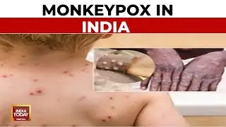 Mpox Case Detected In Man Not From Current Outbreak, No Risk To Public: Centre