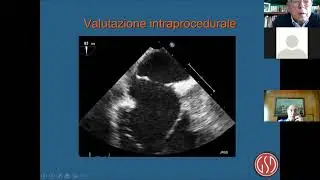 Il difetto interatriale: diagnosi strumentale - Carmelo Arcidiacono