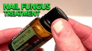 Tea Tree Oil for Fingernail Fungus