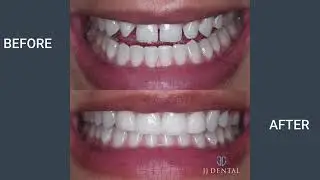 Smile Makeovers by the Best Dentists in Fort Lauderdale