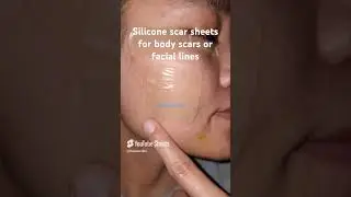 silicone scar sheets for body scars and facial lines. #ScarCare #SkincareRoutine